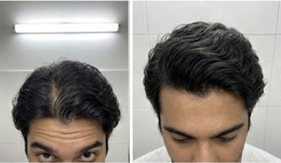 Arjun's hair before and after using the u.elem hair growth serum