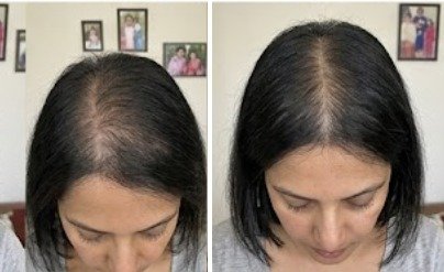 Ishani's hair before and after using the u.elem hair growth serum