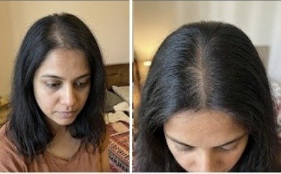 Ishani's hair before and after using the u.elem hair growth serum