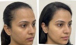 Priya's hair before and after using the u.elem hair growth serum