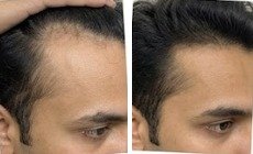 Vikram's hair before and after using the u.elem hair growth serum