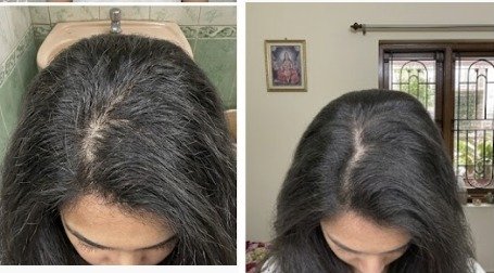 Archana's hair parting before and after using the u.elem shampoo