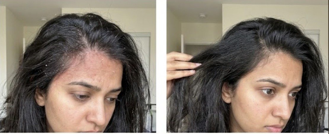 Dharaa's scalp before and after using the u.elem shampoo