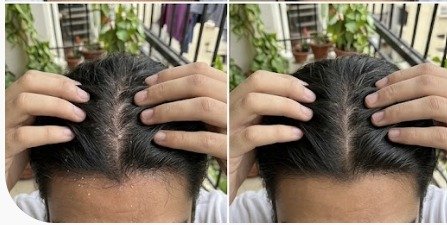 Nilesh's scalp before and after using the u.elem shampoo